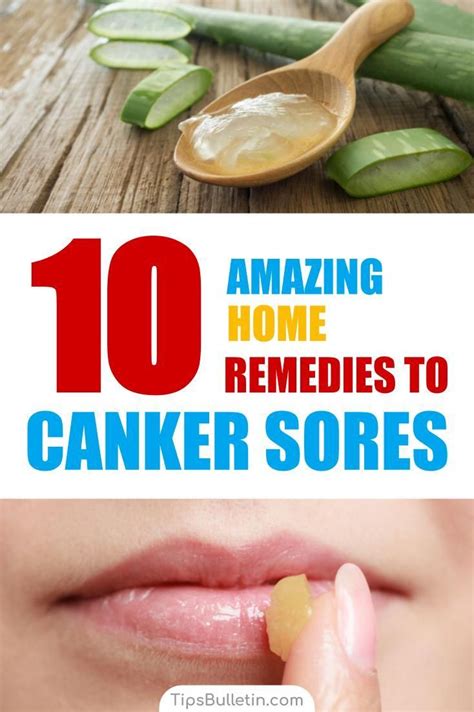 Remedies for Canker Sores: What to Do and When to See a .